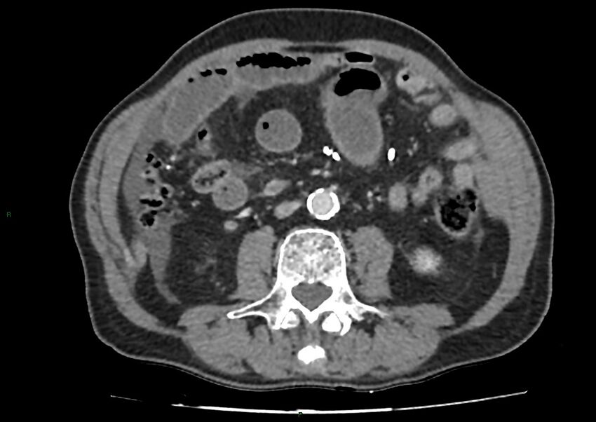 Closed loop small bowel obstruction with ischemia (Radiopaedia 84180-99456 A 60).jpg
