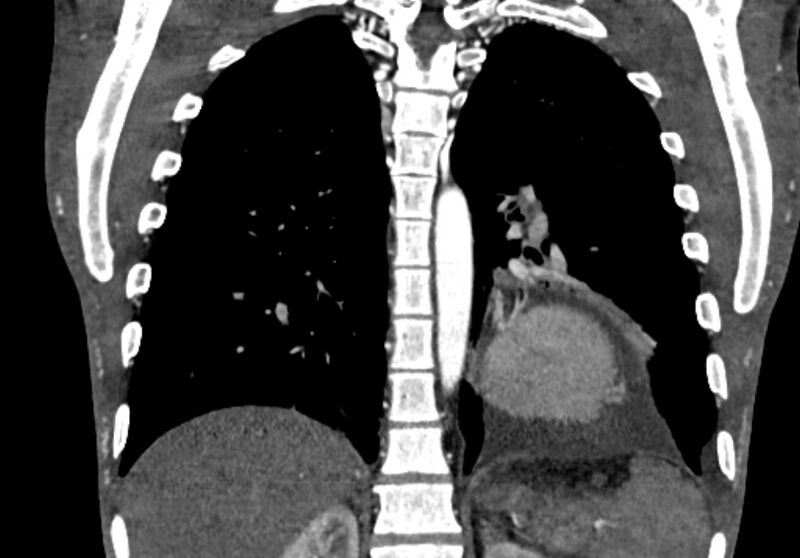File:Coarctation of aorta with aortic valve stenosis (Radiopaedia 70463-80574 C 172).jpg