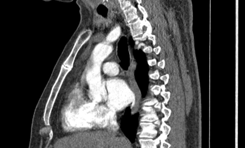 Coarctation of the aorta (Radiopaedia 53363-59343 B 27).jpg