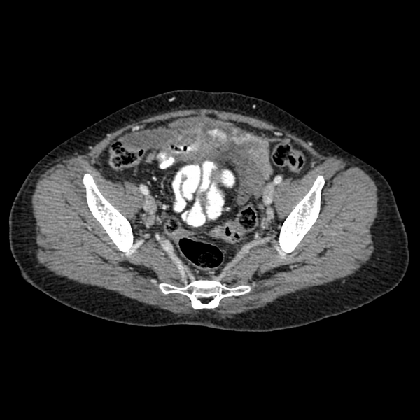 File:Cocoon abdomen with possible tubo-ovarian abscess (Radiopaedia 46235-50636 A 37).png