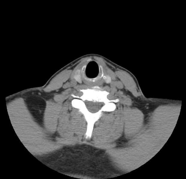 File:Colloid cyst of thyroid (Radiopaedia 22897-22923 Axial non-contrast 37).jpg