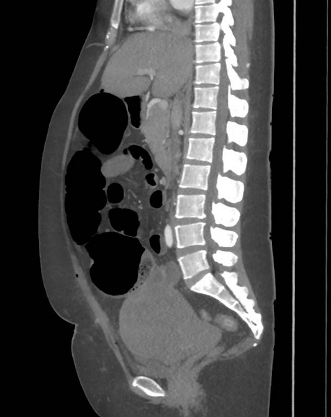 File:Colonic pseudo-obstruction (Radiopaedia 79752-92980 C 38).png
