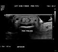 Flat face on finger ultrasound (Rorschach radiology) (Radiopaedia 60188).jpg