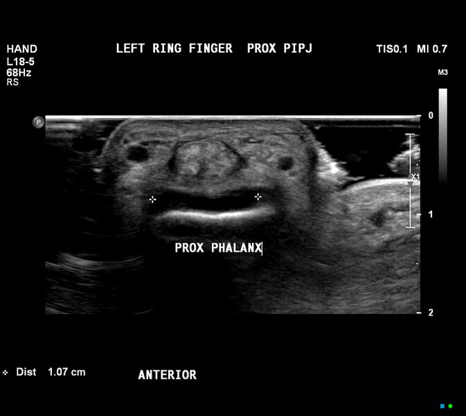 File:Flat face on finger ultrasound (Rorschach radiology) (Radiopaedia 60188).jpg
