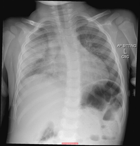 File:Multilobar pneumonia - pediatric (Radiopaedia 63910).jpg