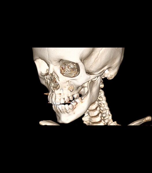 File:Nasoorbitoethmoid fracture (Radiopaedia 90044-107205 3D VRT 25).jpg