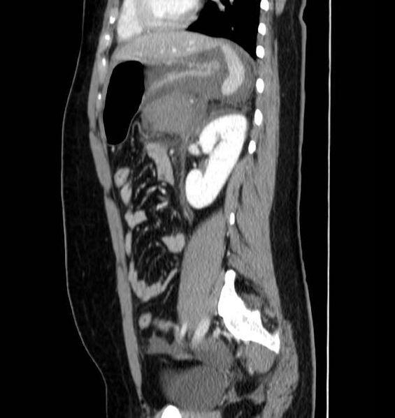File:Necrotizing pancreatitis (Radiopaedia 23001-23031 C 53).jpg