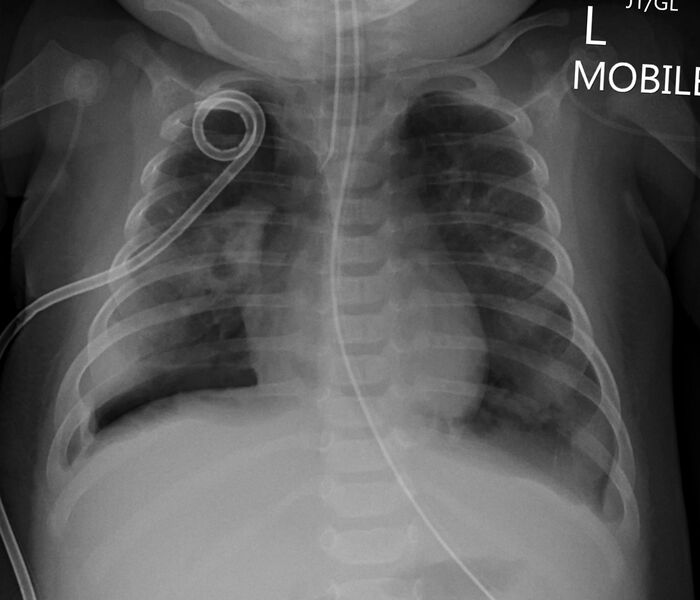 File:Neonatal pneumothorax (Radiopaedia 27206-27375 Frontal 1).jpg