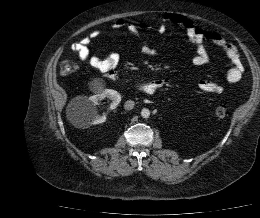 Nephroptosis with inguinal hernia containing perirenal fat (Radiopaedia 56632-63391 C 155).jpg