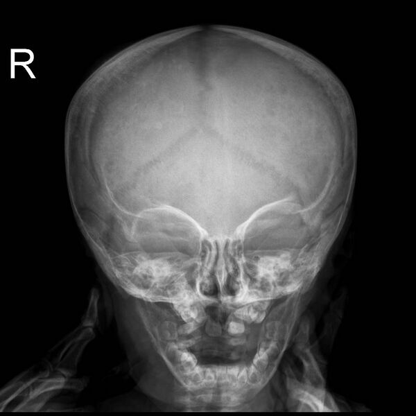 File:Neuroblastoma with skull metastases (Radiopaedia 30326-30957 Frontal 1).jpg