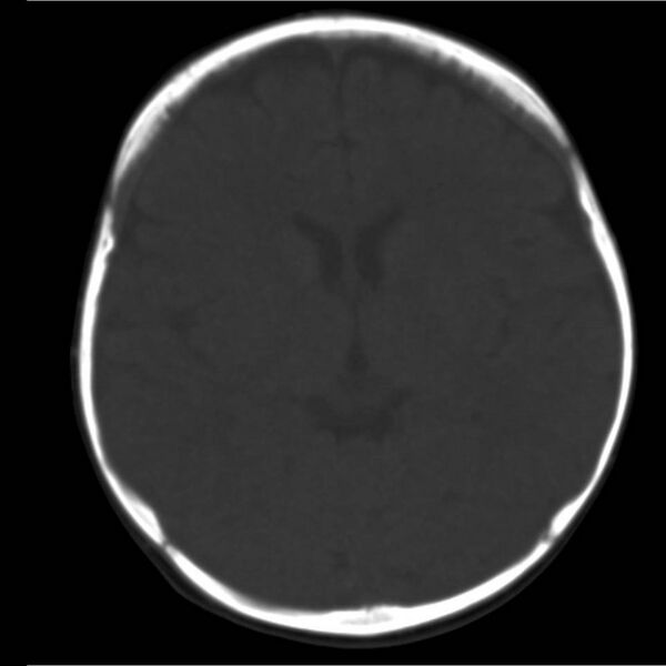 File:Neuroblastoma with skull metastases (Radiopaedia 30326-30958 Axial bone window 10).jpg