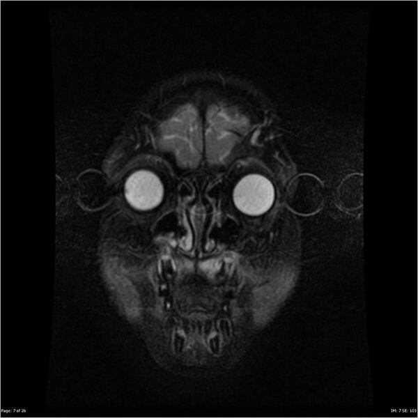 File:Neurofibromatosis type 1 (Radiopaedia 22541-22564 Coronal T1 16).jpg