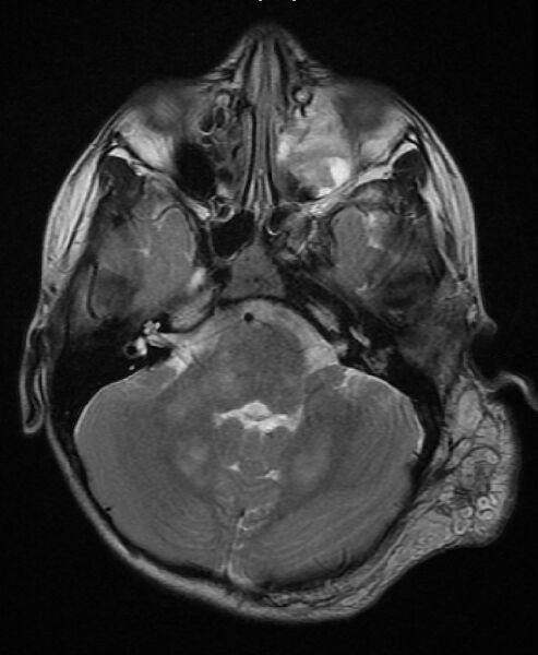 File:Neurofibromatosis type 1 (Radiopaedia 6954-8063 Axial T2 2).jpg