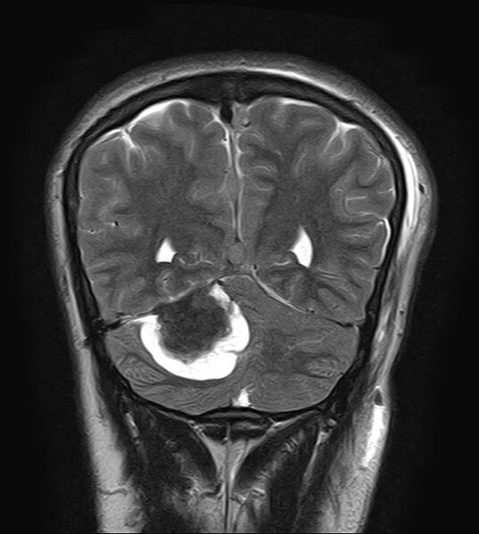 File:Neurofibromatosis type 2 (Radiopaedia 66211-75401 Coronal T2 19).jpg