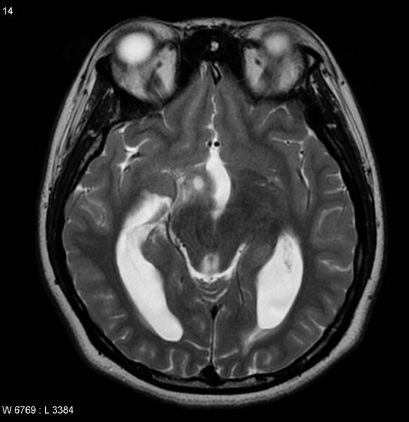 File:Neurofibromatosis type 2 - cranial and spinal involvement (Radiopaedia 5351-7111 Axial T2 11).jpg