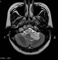 Neurofibromatosis type 2 - cranial and spinal involvement (Radiopaedia 5351-7111 Axial T2 3).jpg