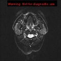 Neuroglial cyst (Radiopaedia 10713-11184 Axial DWI 23).jpg