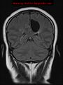 Neuroglial cyst (Radiopaedia 10713-11184 Coronal FLAIR 9).jpg