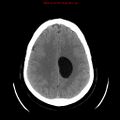 Neuroglial cyst (Radiopaedia 10713-11185 Axial non-contrast 11).jpg
