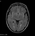 Neurosarcoidosis (Radiopaedia 10930-17204 Axial FLAIR 9).jpg