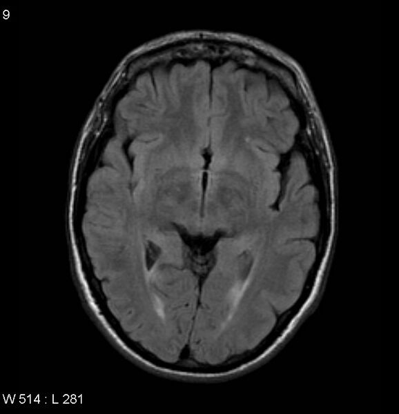 File:Neurosarcoidosis (Radiopaedia 10930-17204 Axial FLAIR 9).jpg