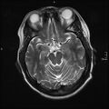 Neurotoxoplasmosis - concentric target sign (Radiopaedia 70644-80784 Axial T2 8).jpg