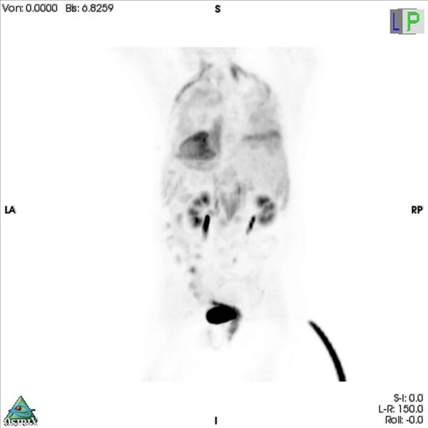 File:Non-Hodgkin lymphoma involving seminal vesicles with development of interstitial pneumonitis during Rituximab therapy (Radiopaedia 32703-33761 PET cor 3D MIP 6).jpg