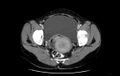 Non-puerperal uterine inversion (Radiopaedia 78343-91094 A 44).jpg