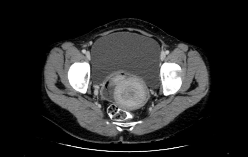 File:Non-puerperal uterine inversion (Radiopaedia 78343-91094 A 44).jpg