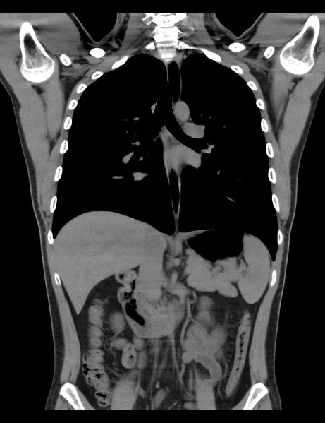 File:Normal CT virtual gastroscopy (Radiopaedia 29960-30501 E 5).jpg
