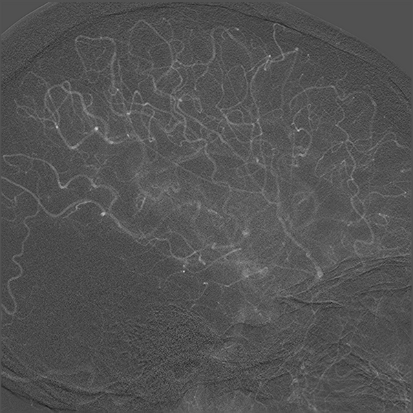 File:Normal cerebral angiogram (four vessel DSA) (Radiopaedia 41708-44649 F 12).png