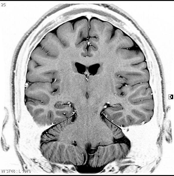 File:Normal coronal brain (Radiopaedia 6676-7910 B 25).jpg