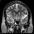 Normal coronal brain (Radiopaedia 6676-7910 Coronal T2 14).jpg