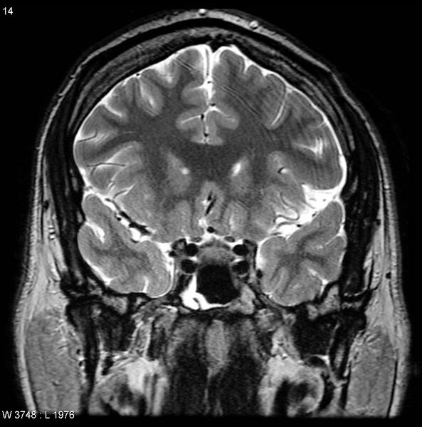 File:Normal coronal brain (Radiopaedia 6676-7910 Coronal T2 14).jpg