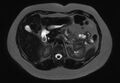 Normal liver MRI with Gadolinium (Radiopaedia 58913-66163 E 17).jpg