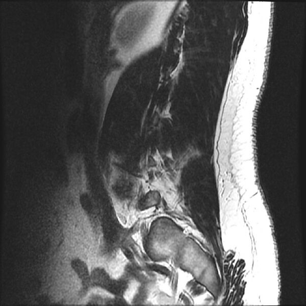 File:Normal lumbar spine MRI (Radiopaedia 43051-46311 Sagittal T2 18).jpg