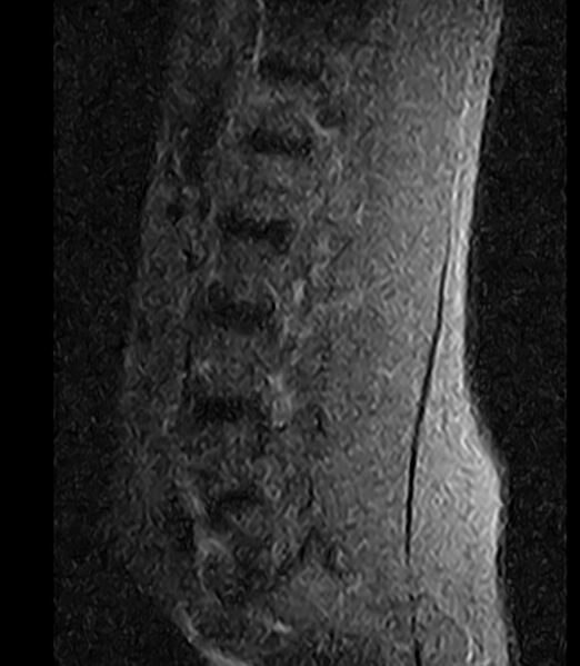 File:Normal lumbar spine MRI - low-field MRI scanner (Radiopaedia 40976-43699 Sagittal STIR 10).jpg
