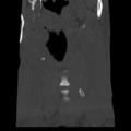 Normal trauma cervical spine (Radiopaedia 41017-43760 Coronal bone window 3).png