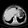 Nutmeg liver (Radiopaedia 49958-55246 A 10).png