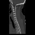 Occipital condyle fracture (Radiopaedia 31755-32691 Sagittal bone window 14).jpg