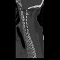 Occipital condyle fracture (Radiopaedia 31755-32691 Sagittal bone window 15).jpg