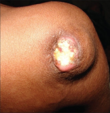 Cutaneous calcification with secondary ulceration File:Dermatomyositis13.jpg