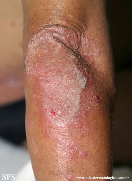 File:Psoriasis (Dermatology Atlas 128).jpg