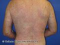 Urticaria (DermNet NZ systemic-w-itchy-skin-67).jpg