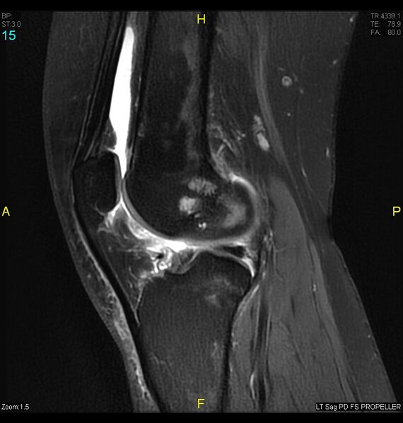 File:ACL mucoid degeration with cystic changes (Radiopaedia 48428-53341 Sagittal PD fat sat 13).jpg