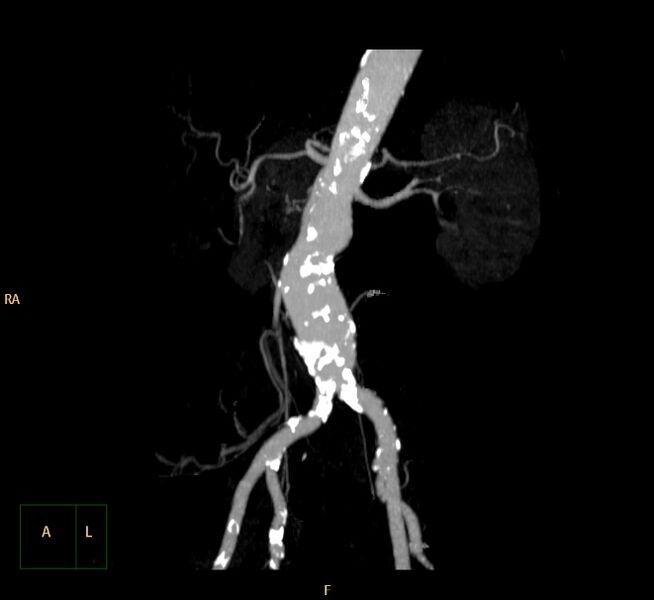File:Abdominal aortic aneurysm (Radiopaedia 23703-23856 MIP 24).jpg