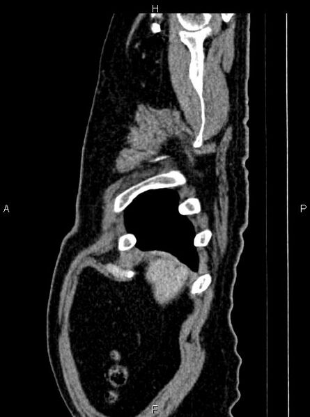 File:Abdominal aortic aneurysm (Radiopaedia 83094-97462 Sagittal renal cortical phase 14).jpg