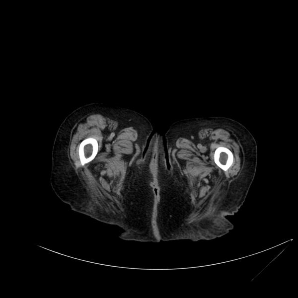 File:Abdominal aortic aneurysm - impending rupture (Radiopaedia 19233-19246 Axial non-contrast 145).jpg