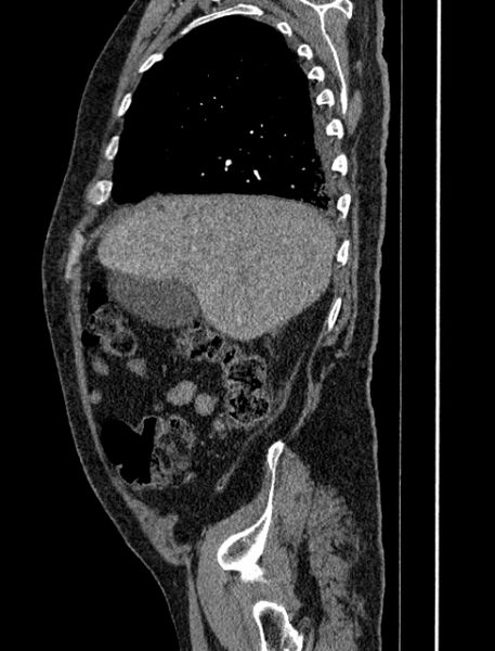 File:Abdominal aortic aneurysm rupture (Radiopaedia 54179-60362 Sagittal C+ arterial phase 7).jpg
