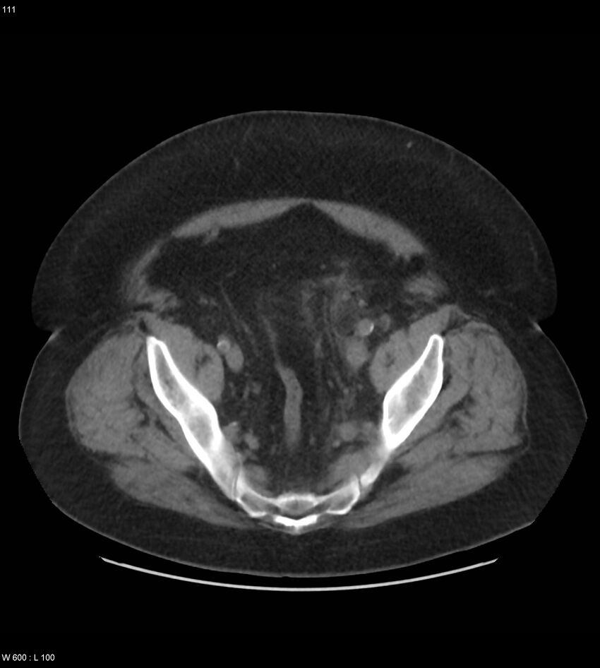 Abdominal aortic aneurysm with intramural hematoma then rupture (Radiopaedia 50278-55631 Axial non-contrast 107).jpg